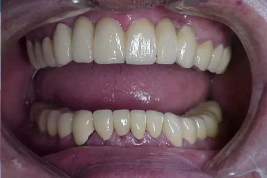 Reabilitação Oral na Odonto J. Digital
